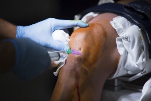 artroza liječenja injekcija zgloba koljena