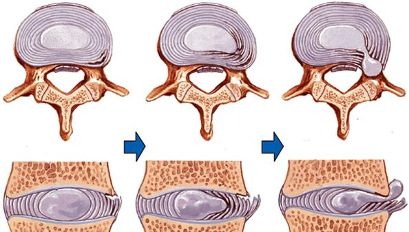 ozljeda kralježnice u osteohondrozi