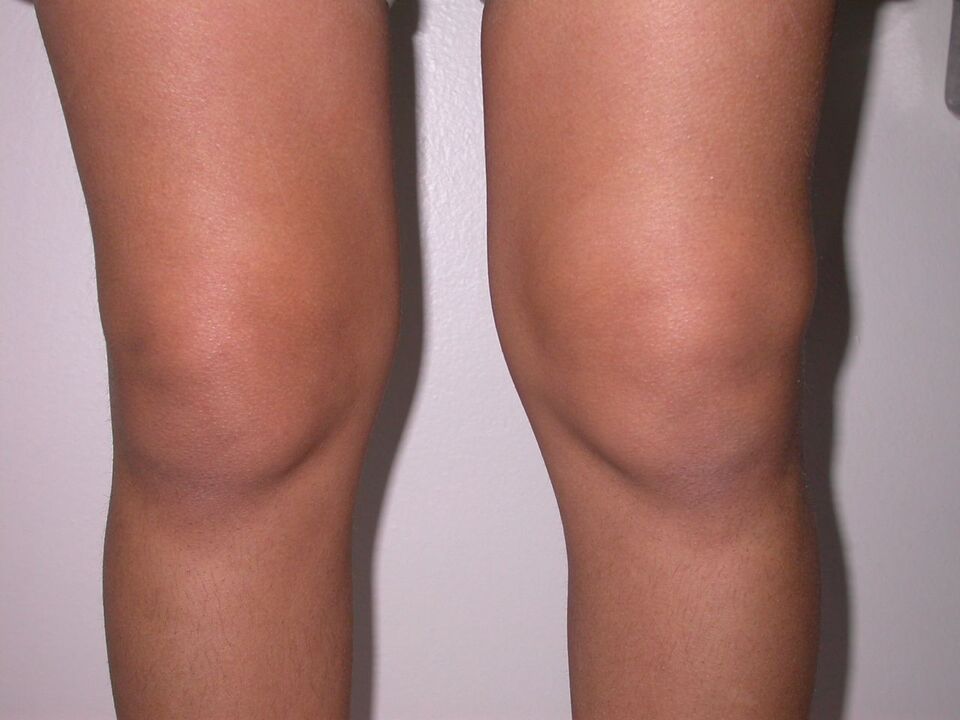 oteklina koljena zbog osteoartritisa