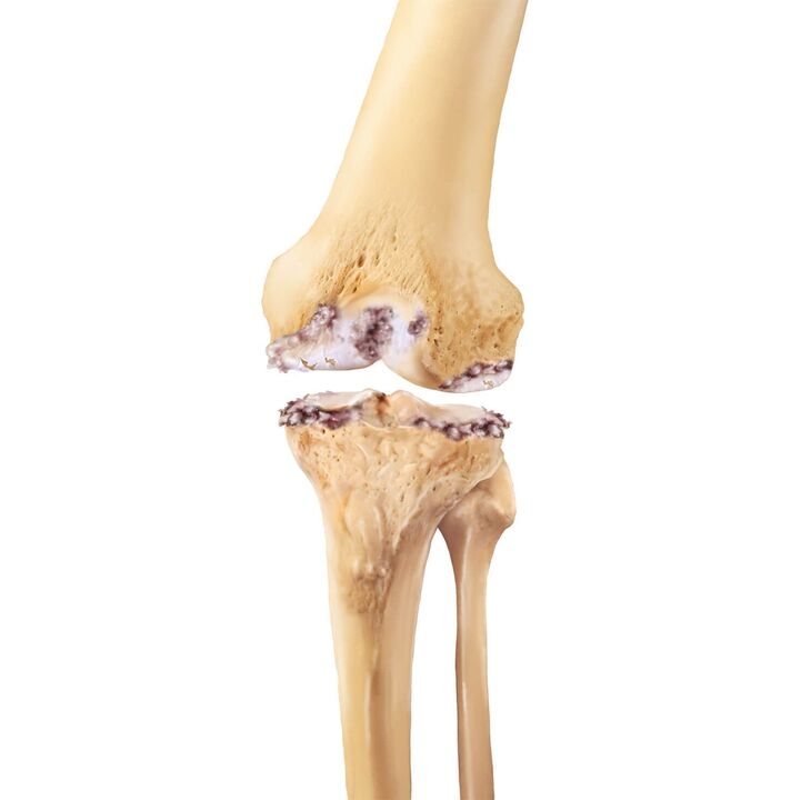 uništavanje zgloba koljena s artrozom