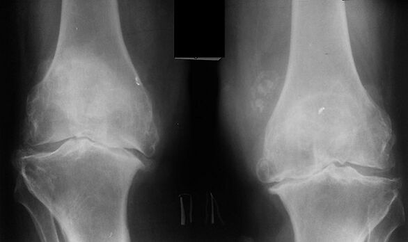 X -Ray kao način dijagnosticiranja artroze zgloba koljena