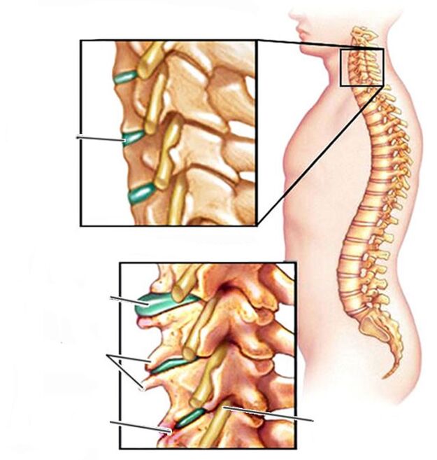 osteohondroza i zdrava vratna kralježnica