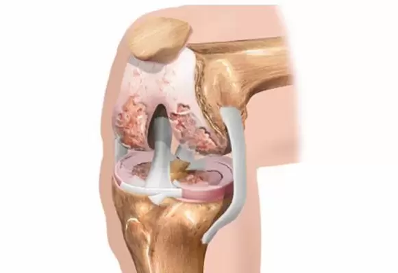 artroza koljena