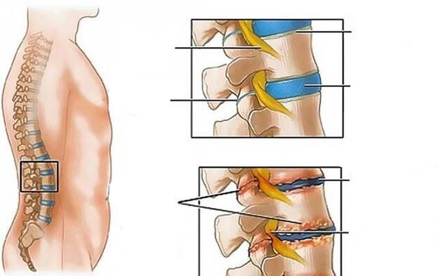 osteohondroza lumbalne kralježnice uzrokuje bolove u leđima